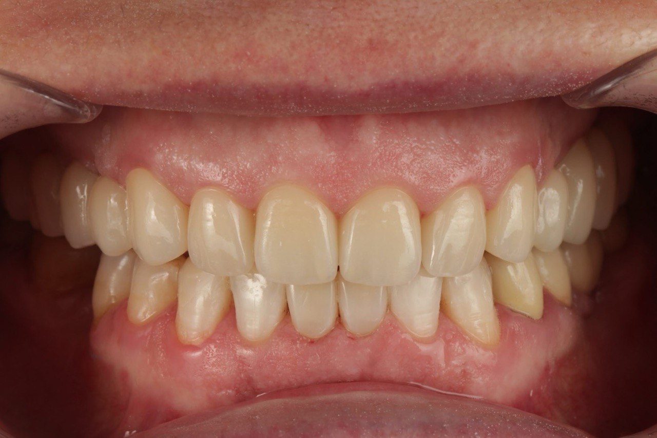 Після протезування