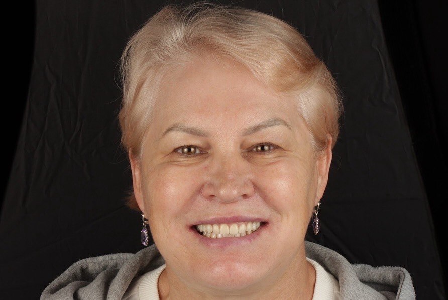 Після протезування