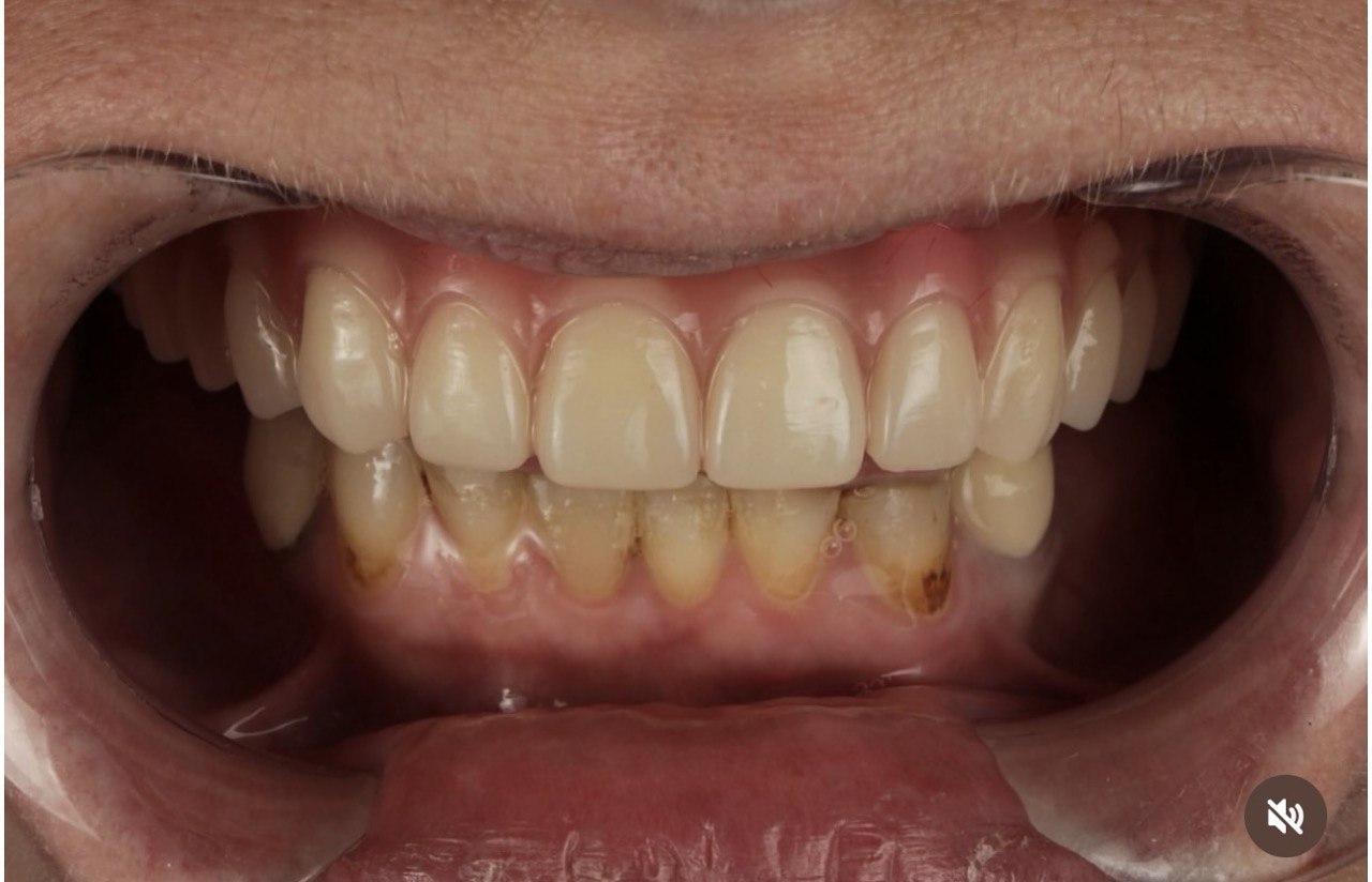 Після протезування