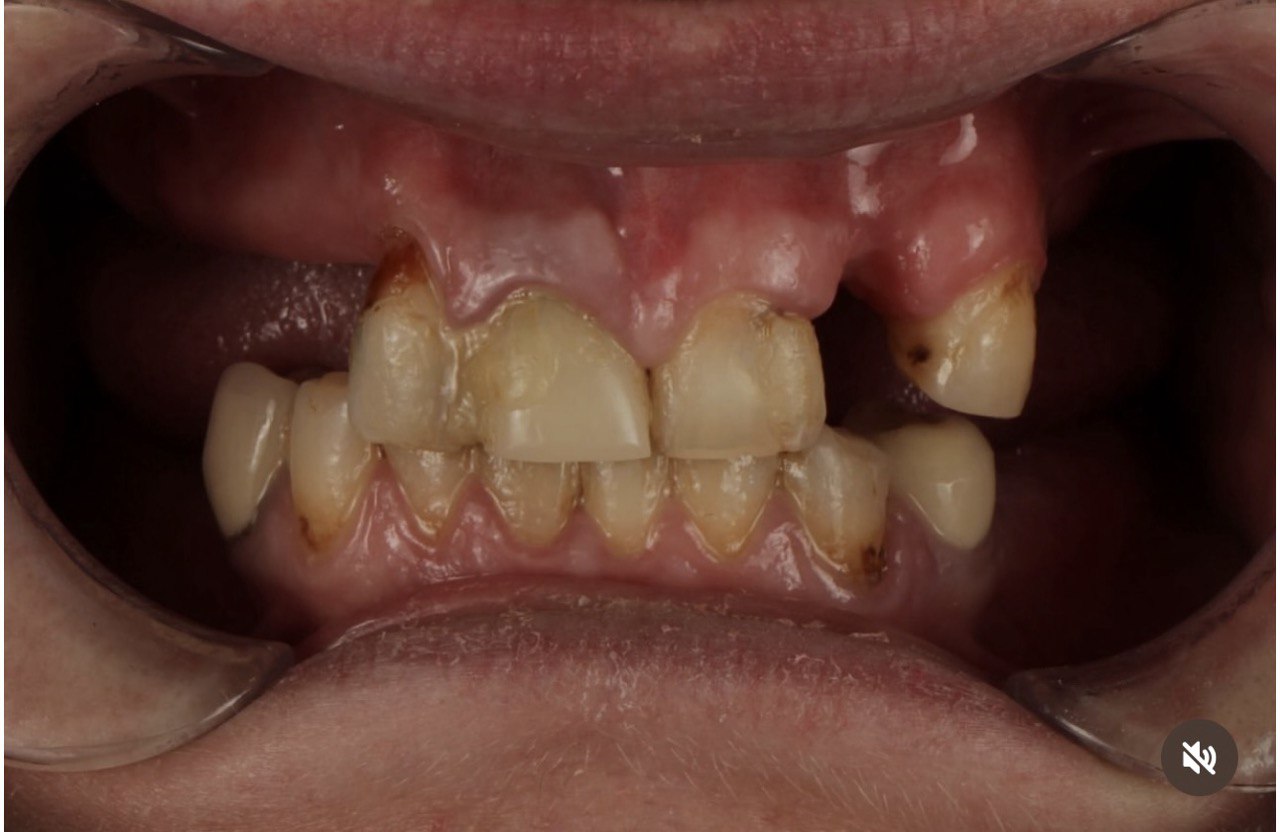 До протезування