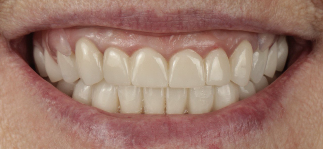 Після протезування