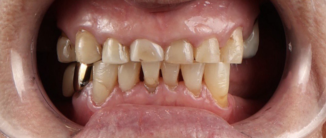 До протезування