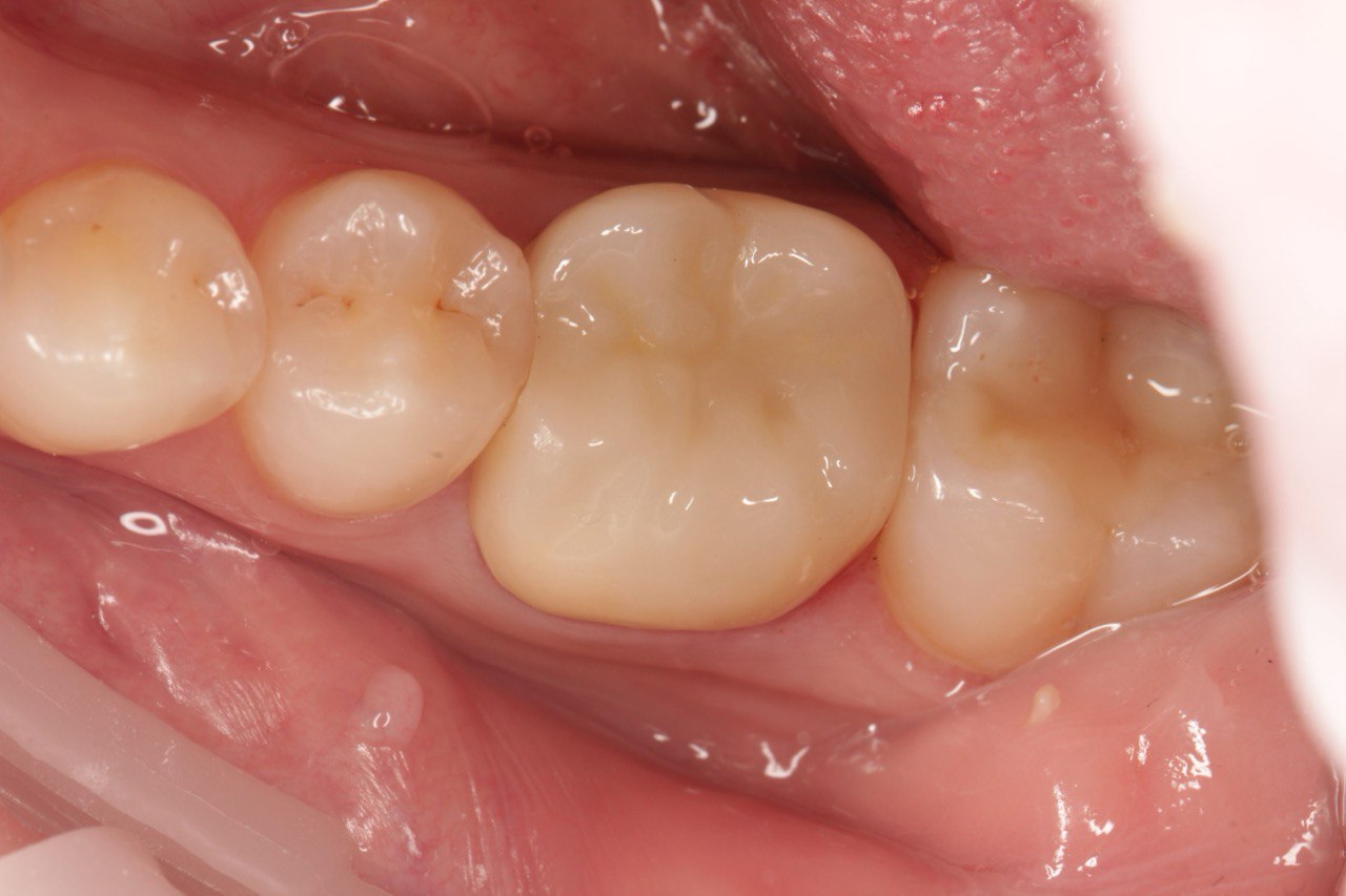 Після протезування