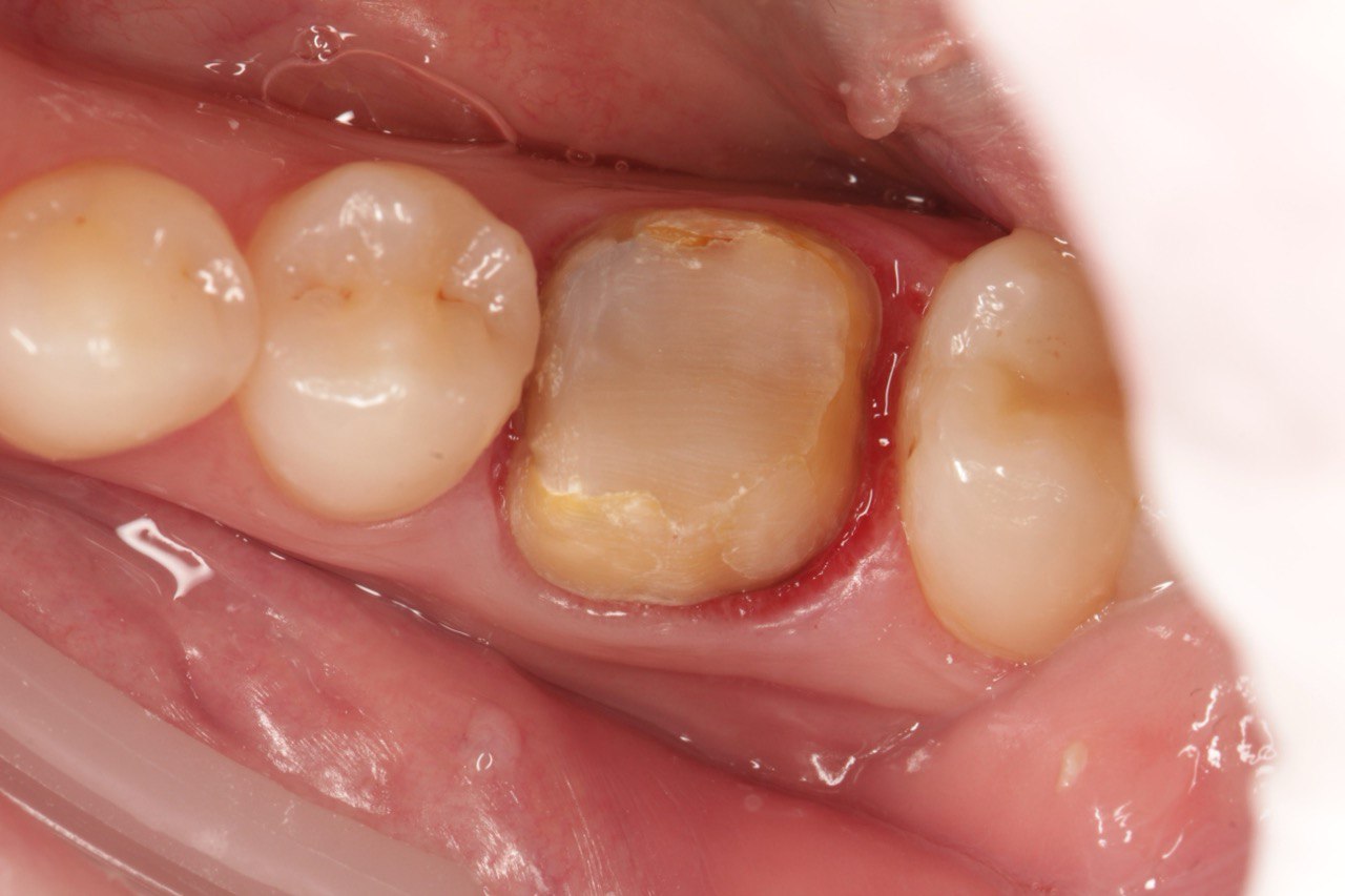 До протезування