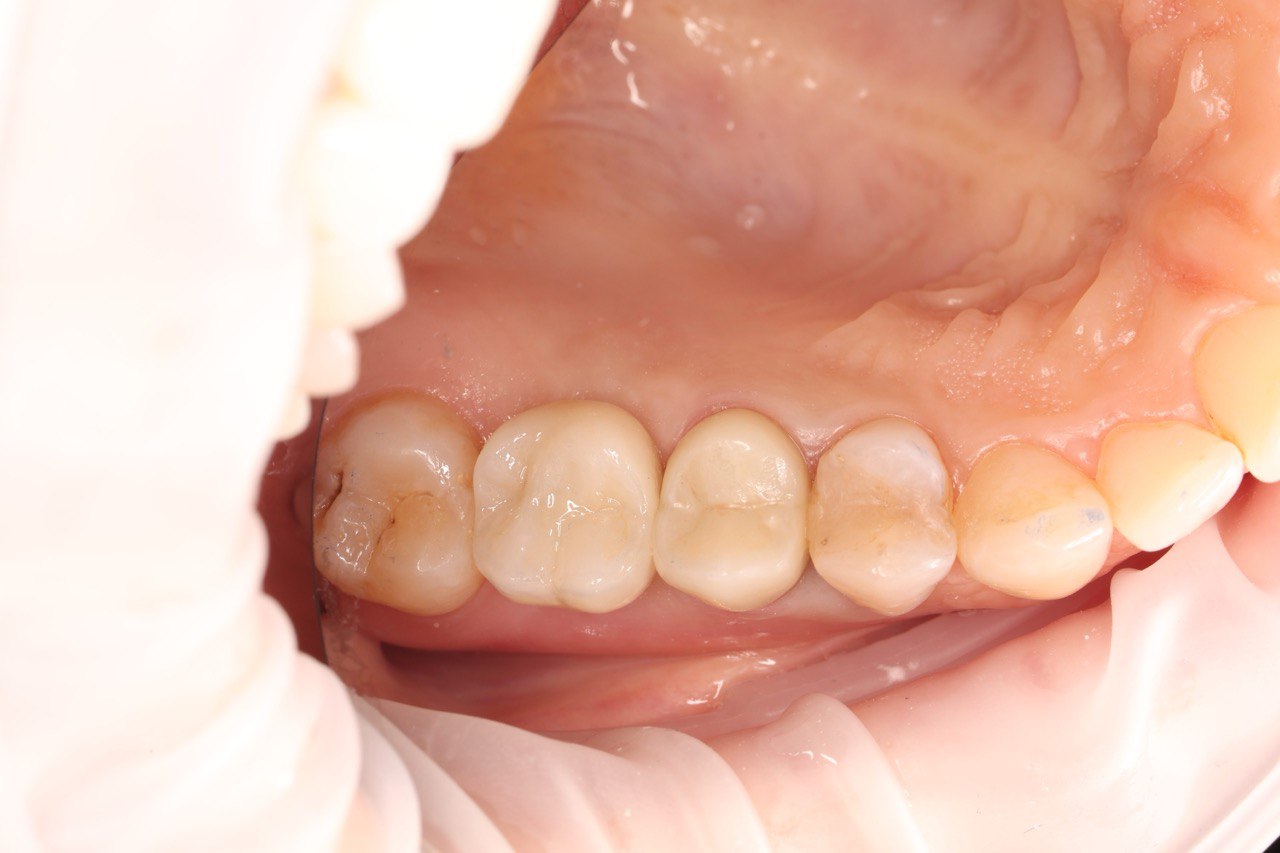 Після протезування