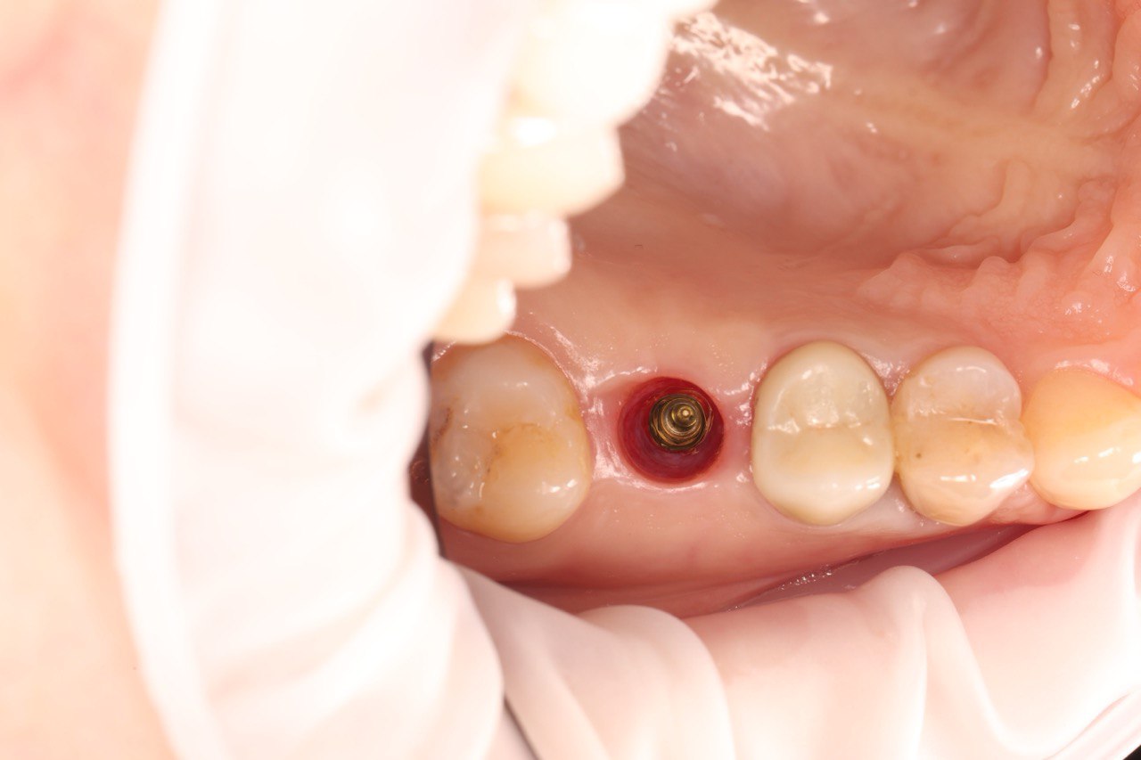 До протезування