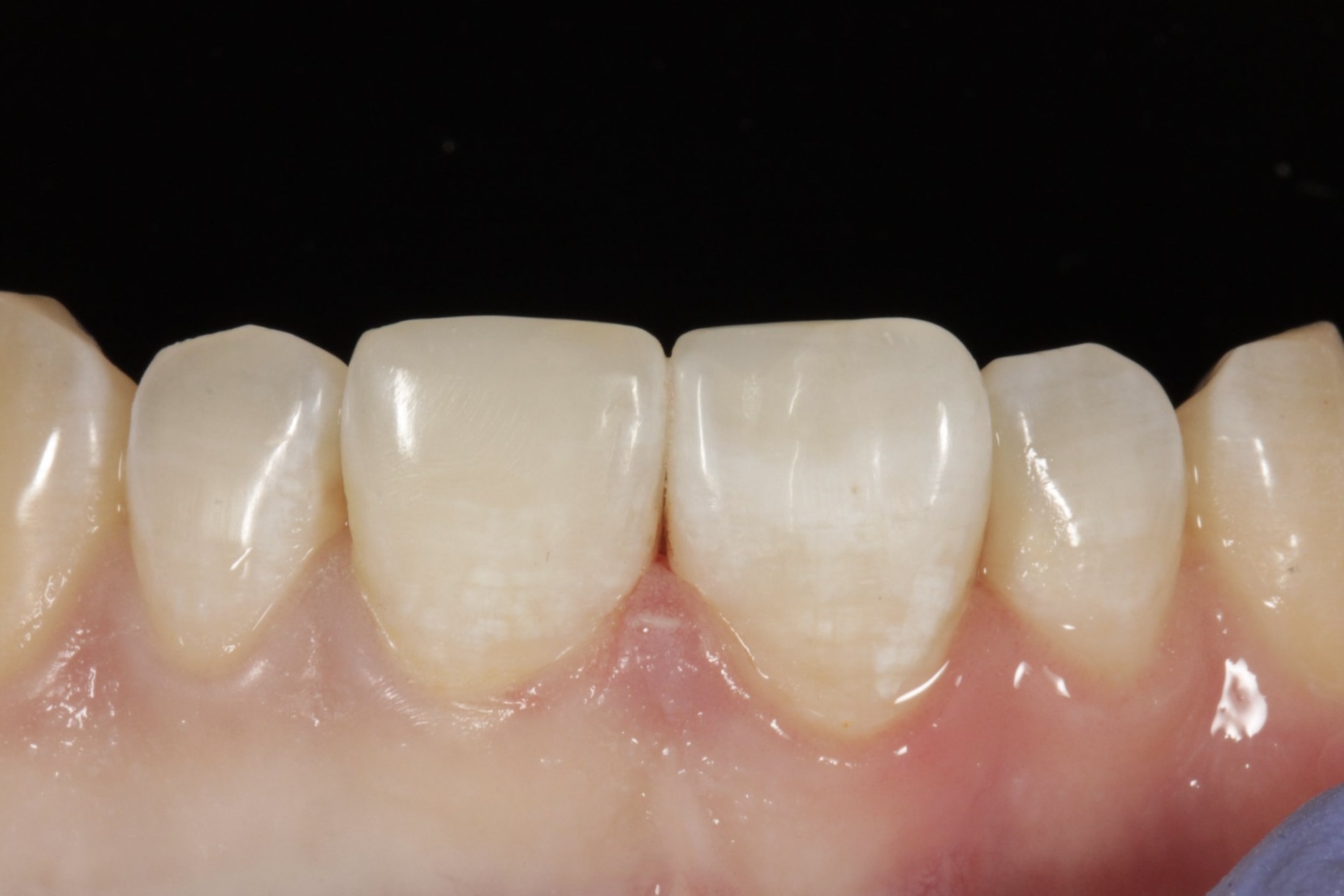 Фото після лікування — кейс 1