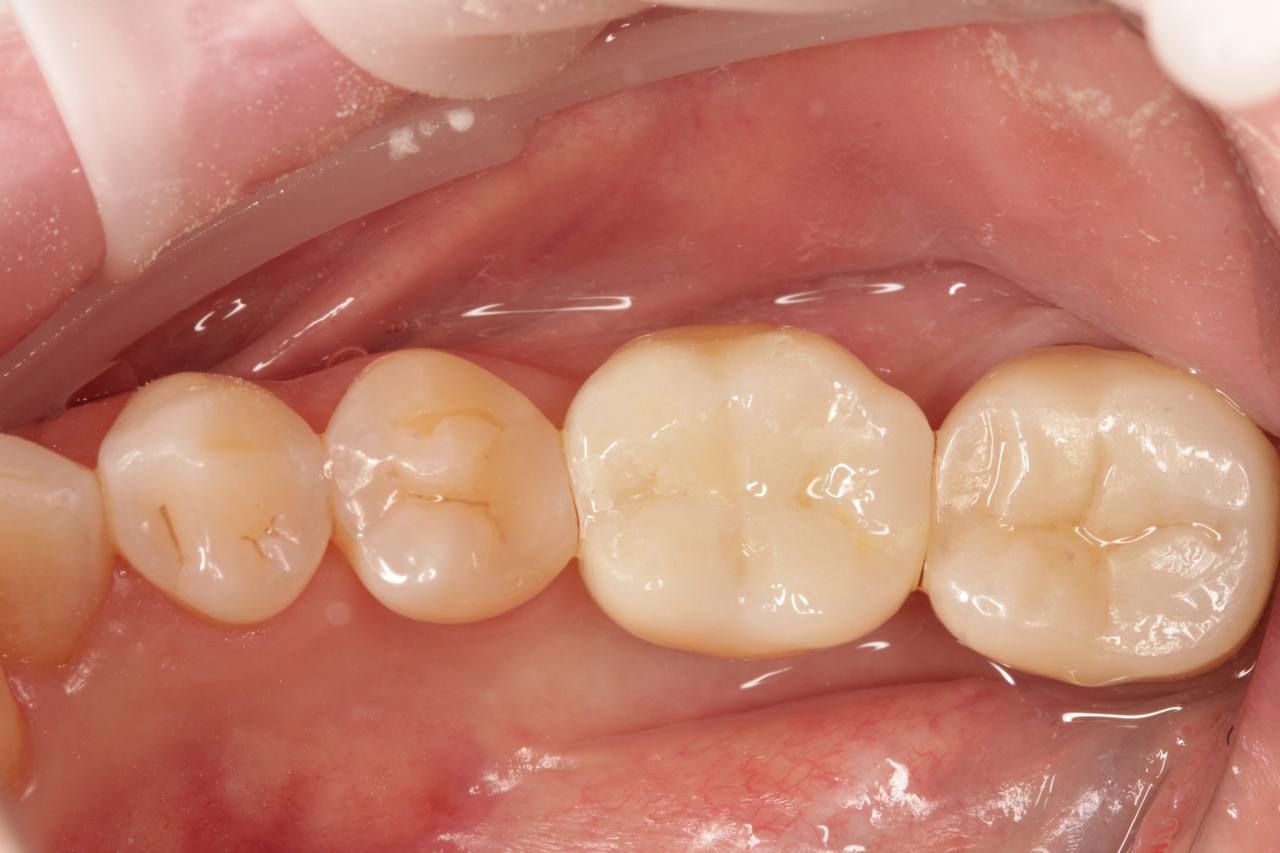 Фото після лікування — кейс 3