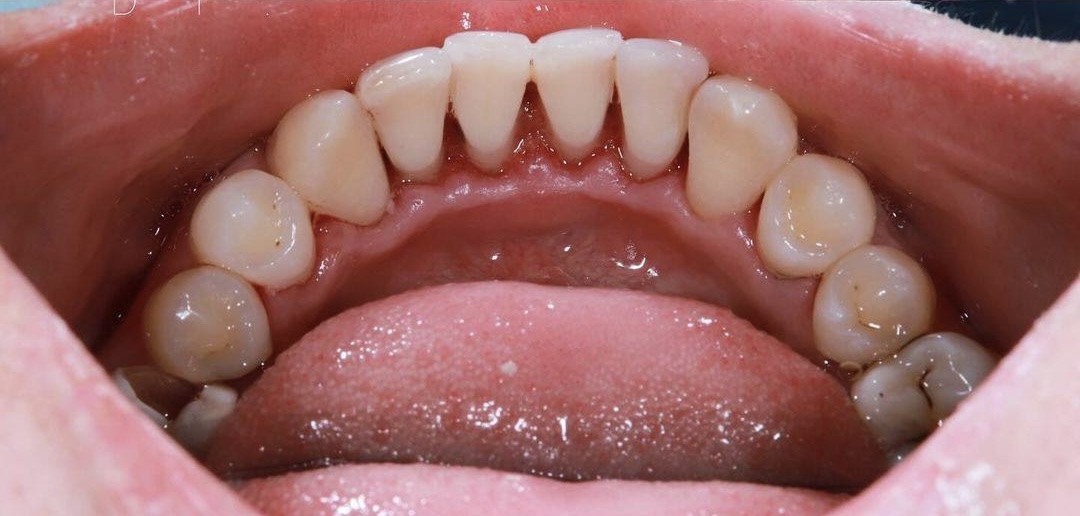 Фото після лікування — кейс 4