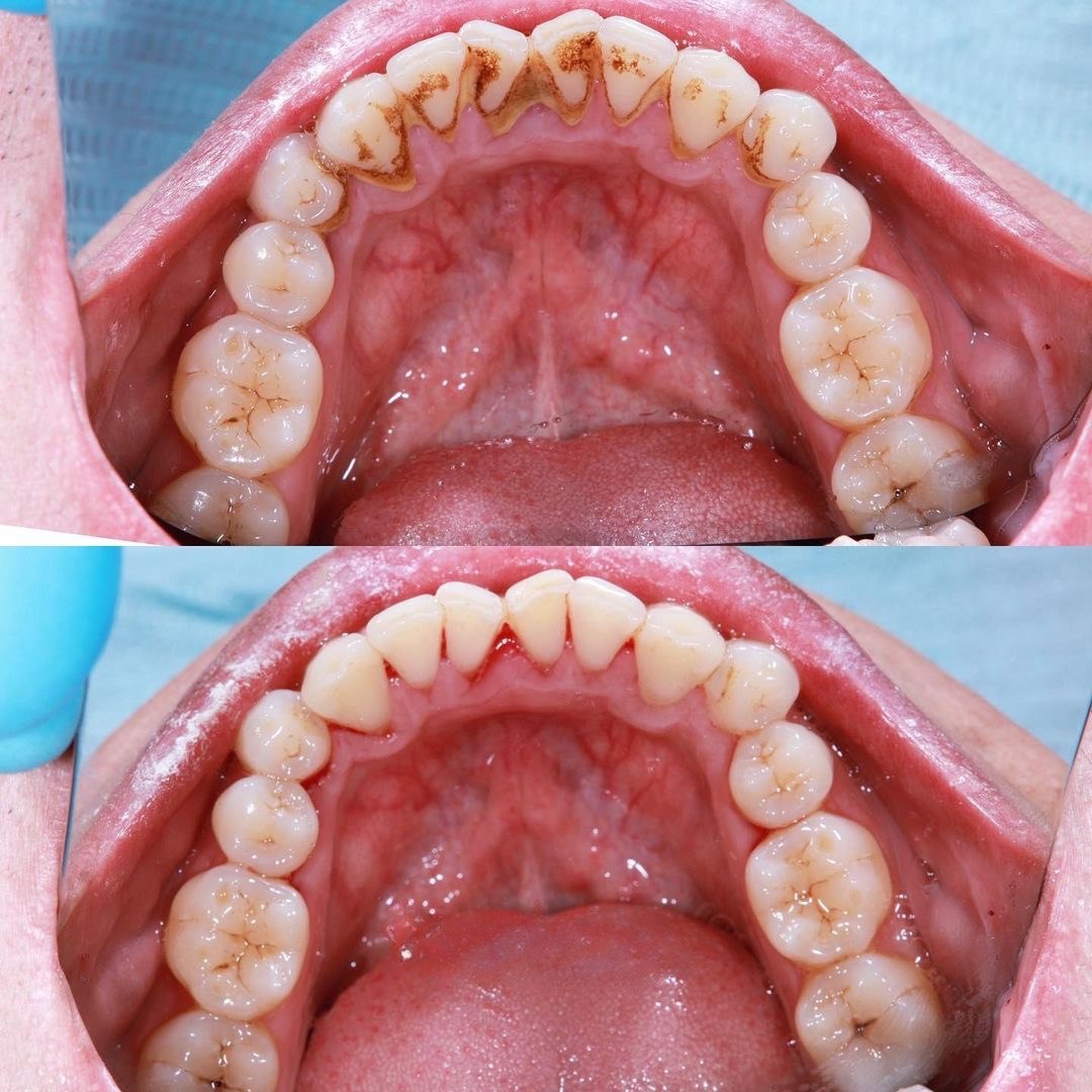 Профгігієна До і Після (Кейс 1)