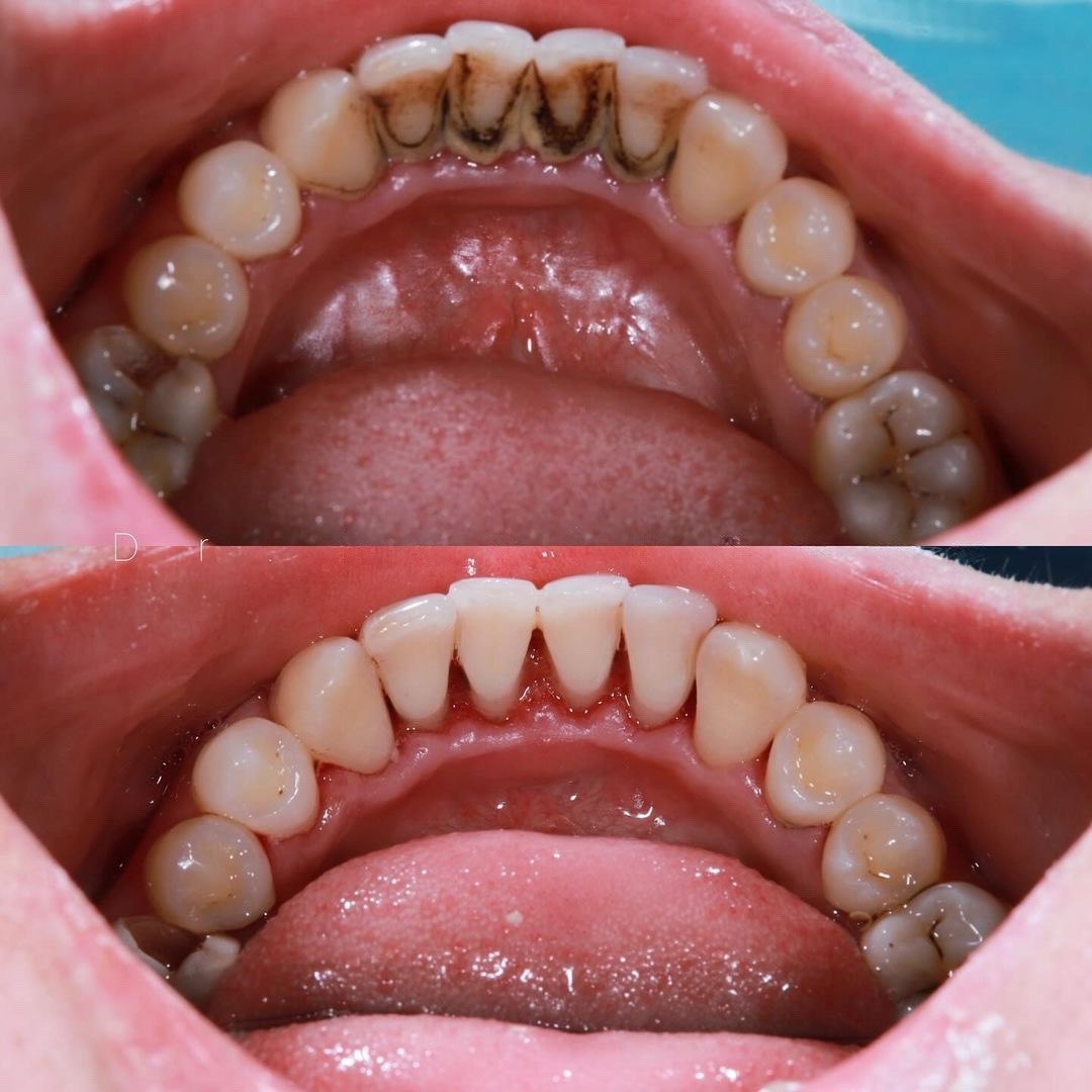 Профгігієна До і Після (Кейс 2)