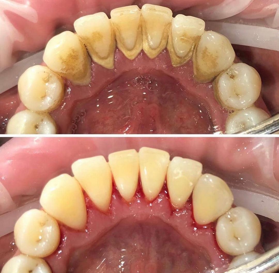 Профгігієна До і Після (Кейс 3)