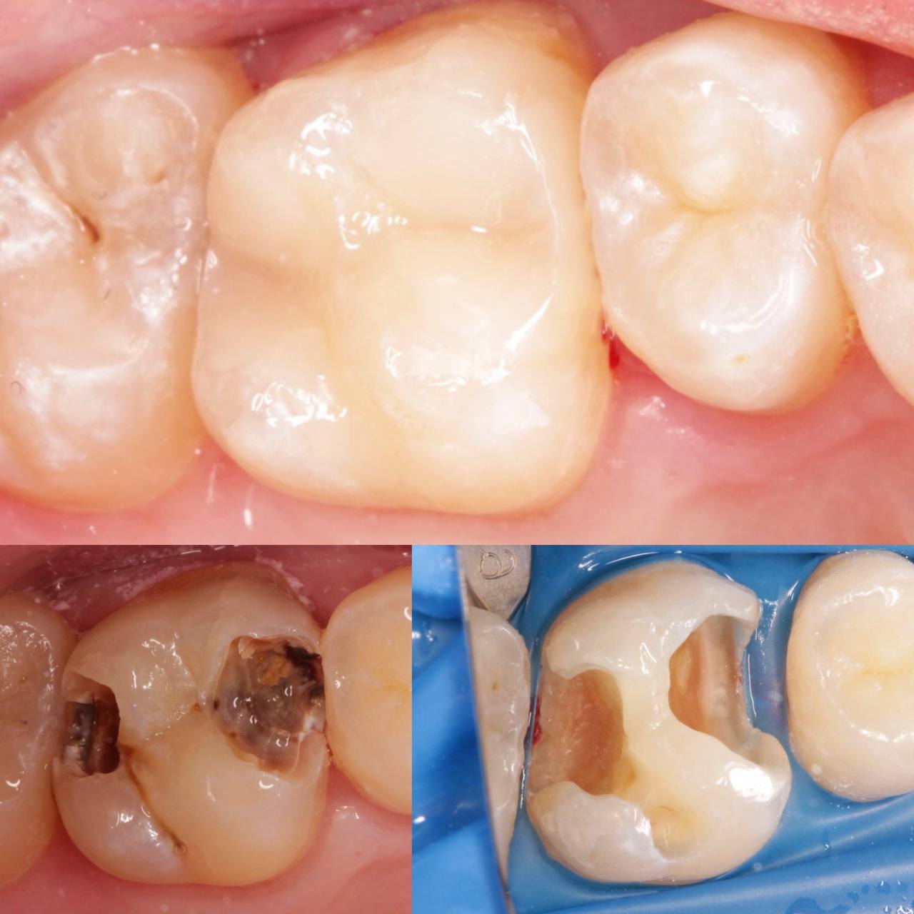 Лікування пульпіту — до та після