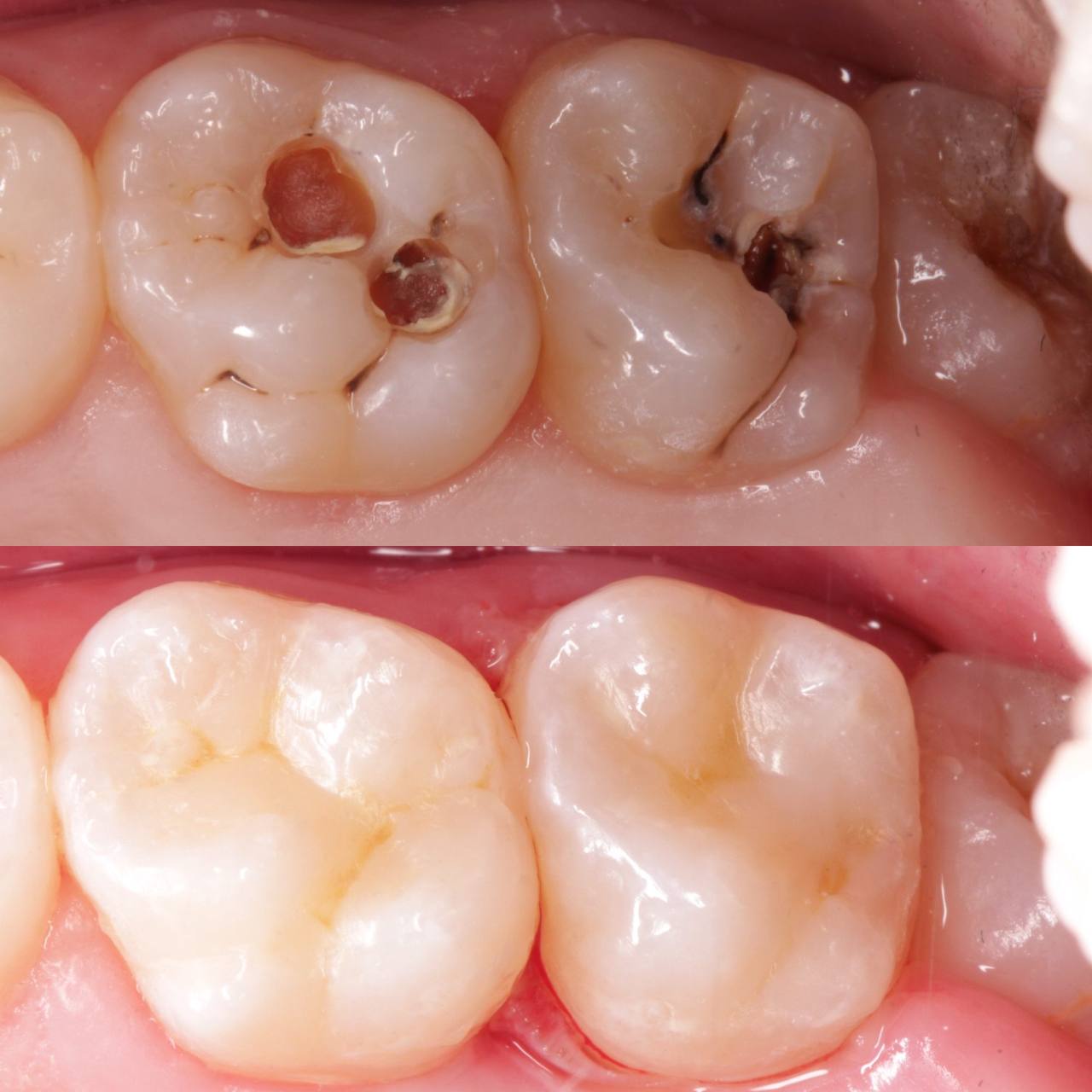 Художня реставрація — до та після