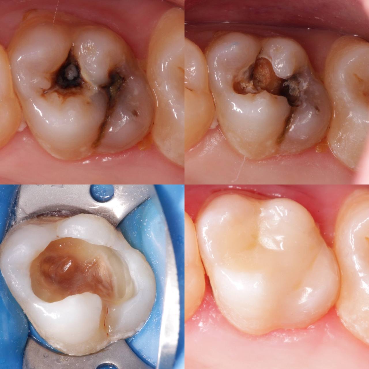 Лікування періодонтиту — до та після
