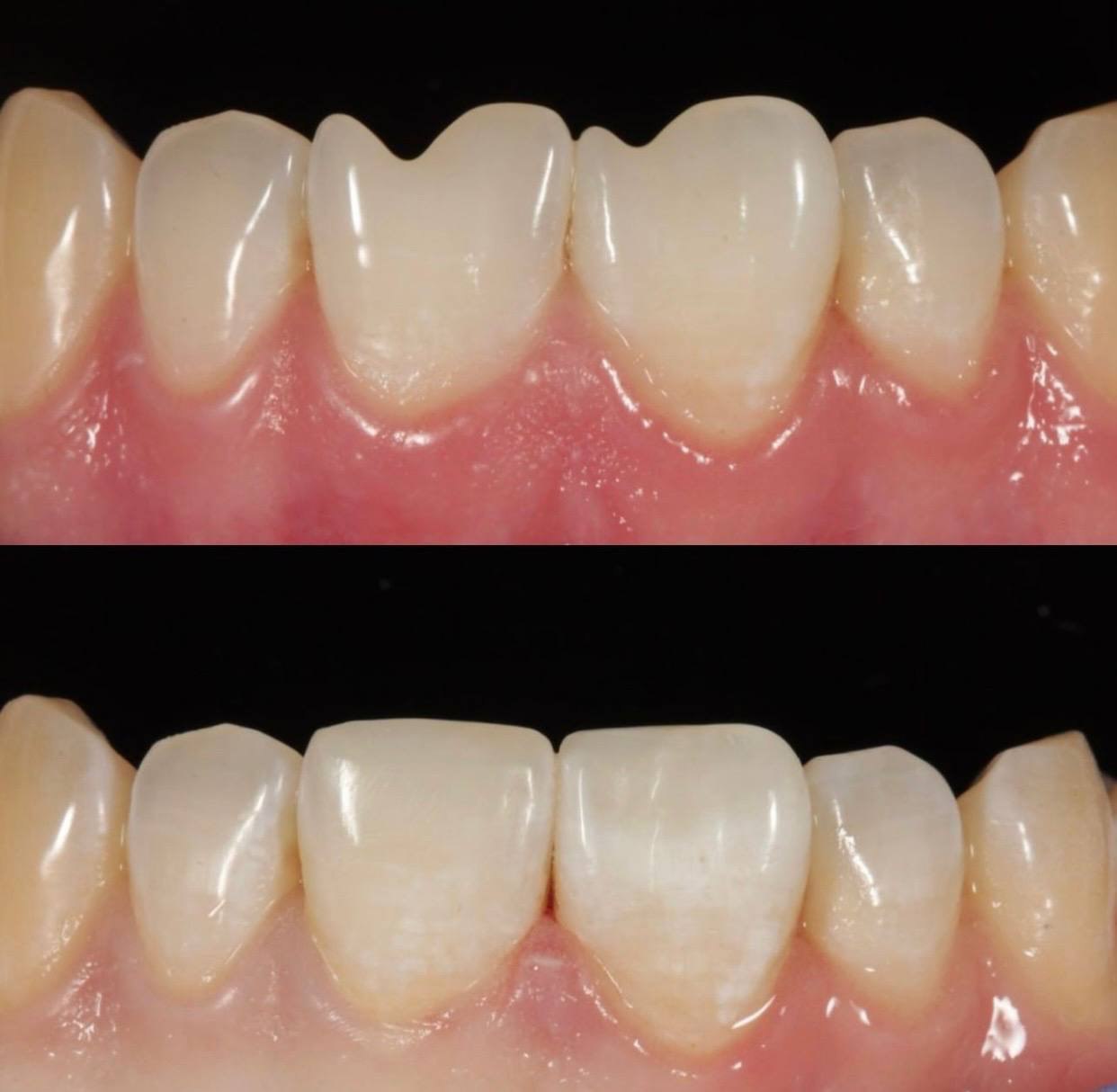 Відновлення зуба — до та після