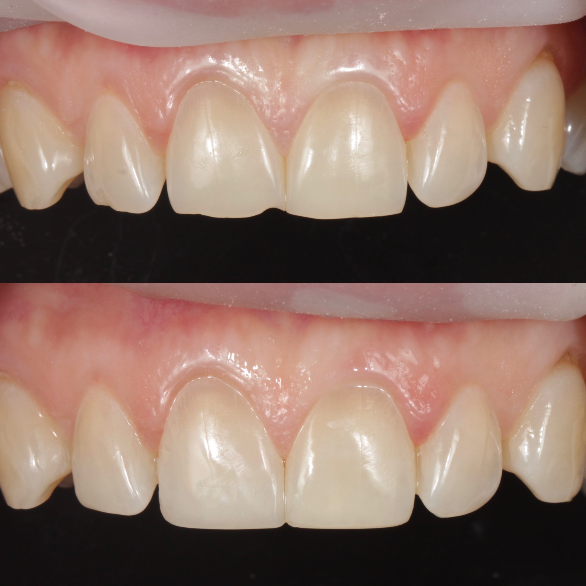 Композитні вініри — до та після